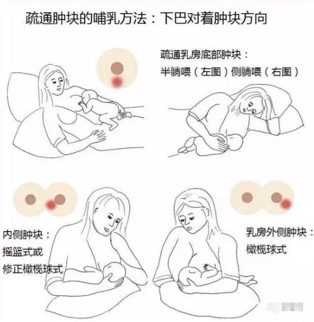 產(chǎn)后漲奶，疼痛難忍怎么辦？