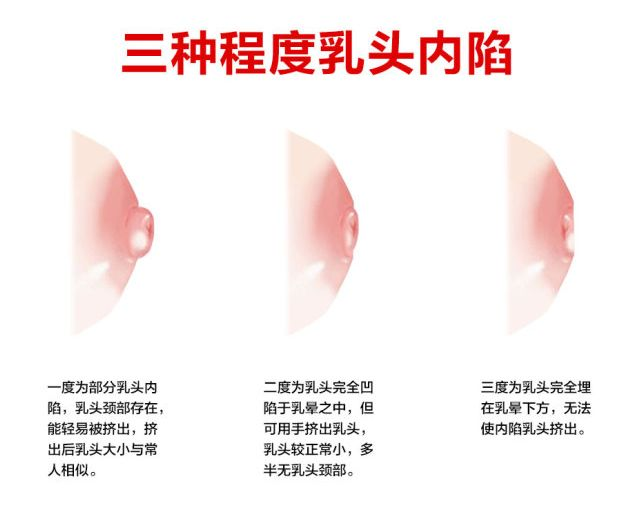 乳頭凹陷的媽媽該如何哺乳？