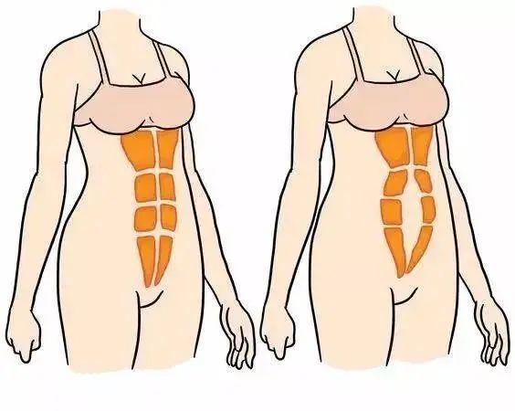 你的腹直肌分離了嗎？一步就知道