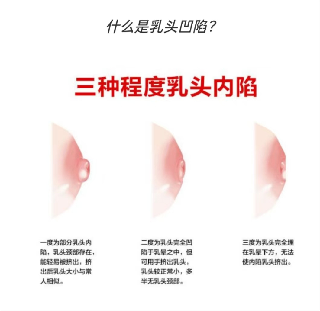 乳頭凹陷的媽媽該如何哺乳？